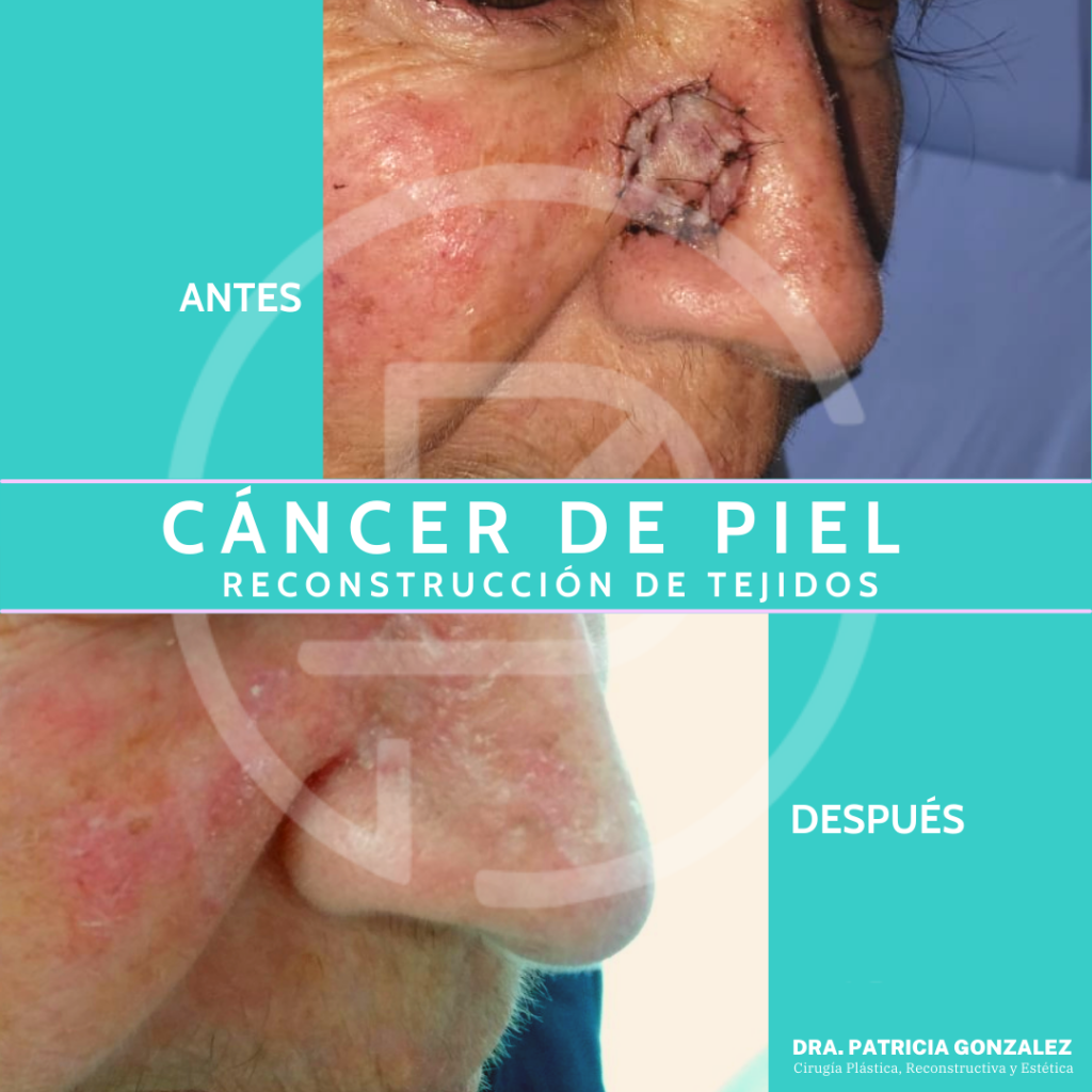 Cancer de piel