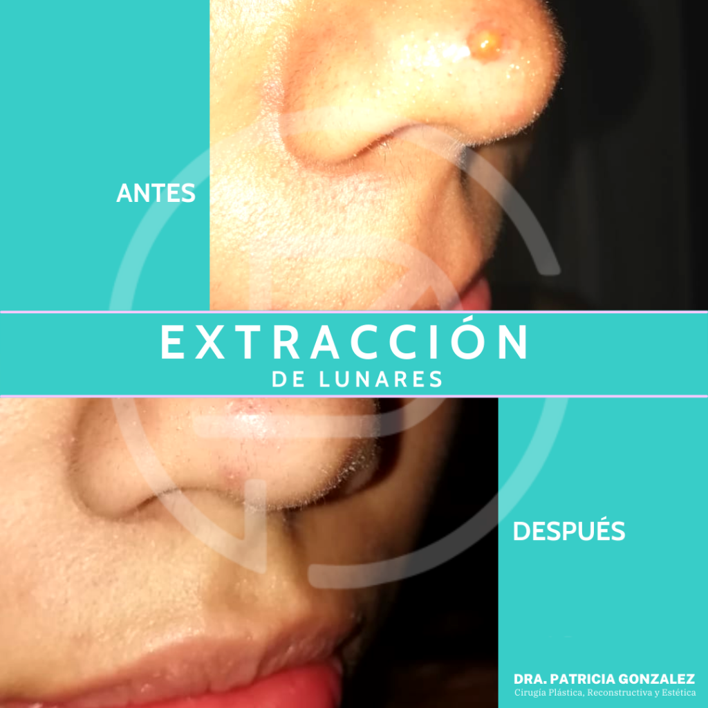 Extracción de lunares