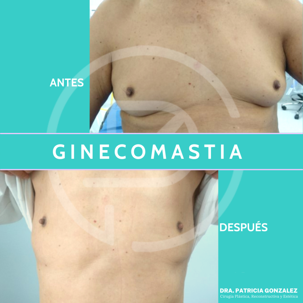 Ginecomastia