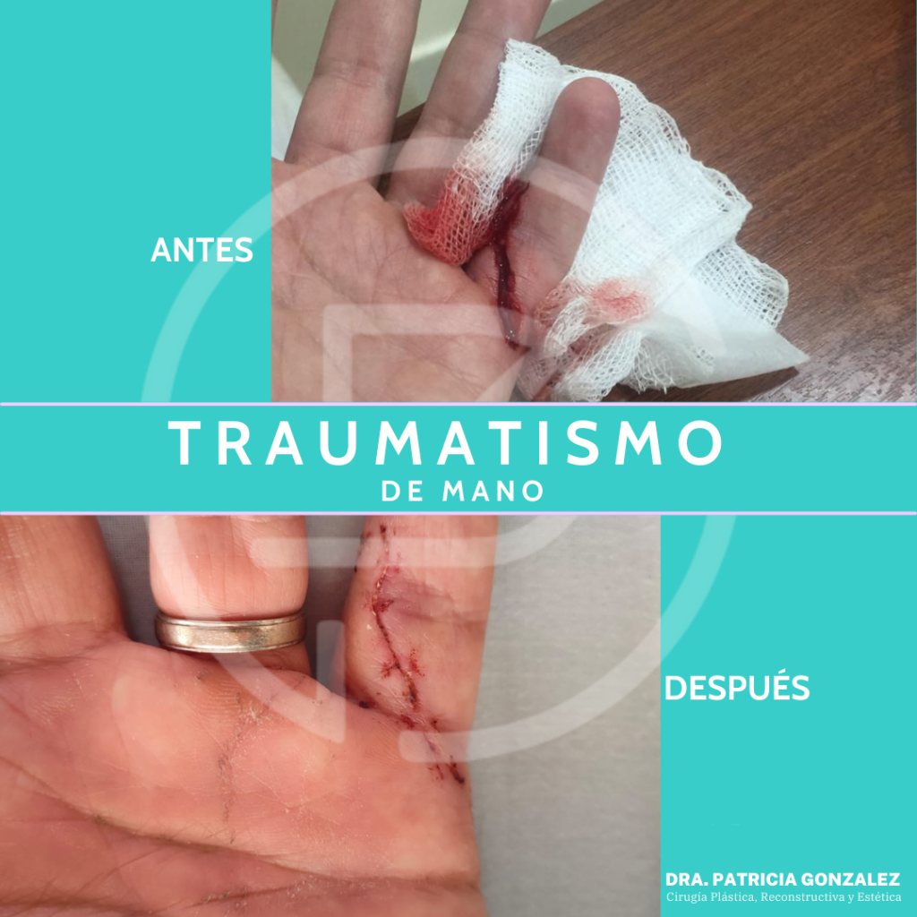 Heridas
