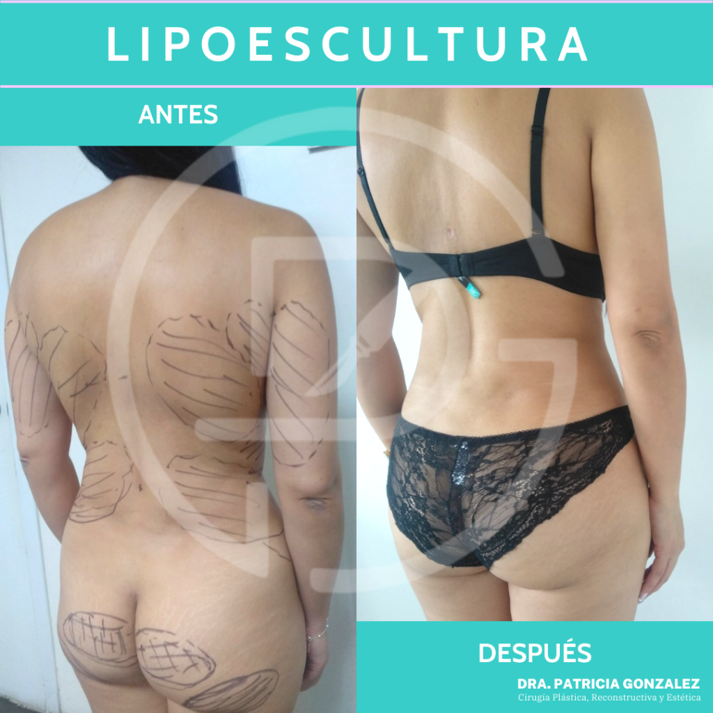 Lipoescultura
