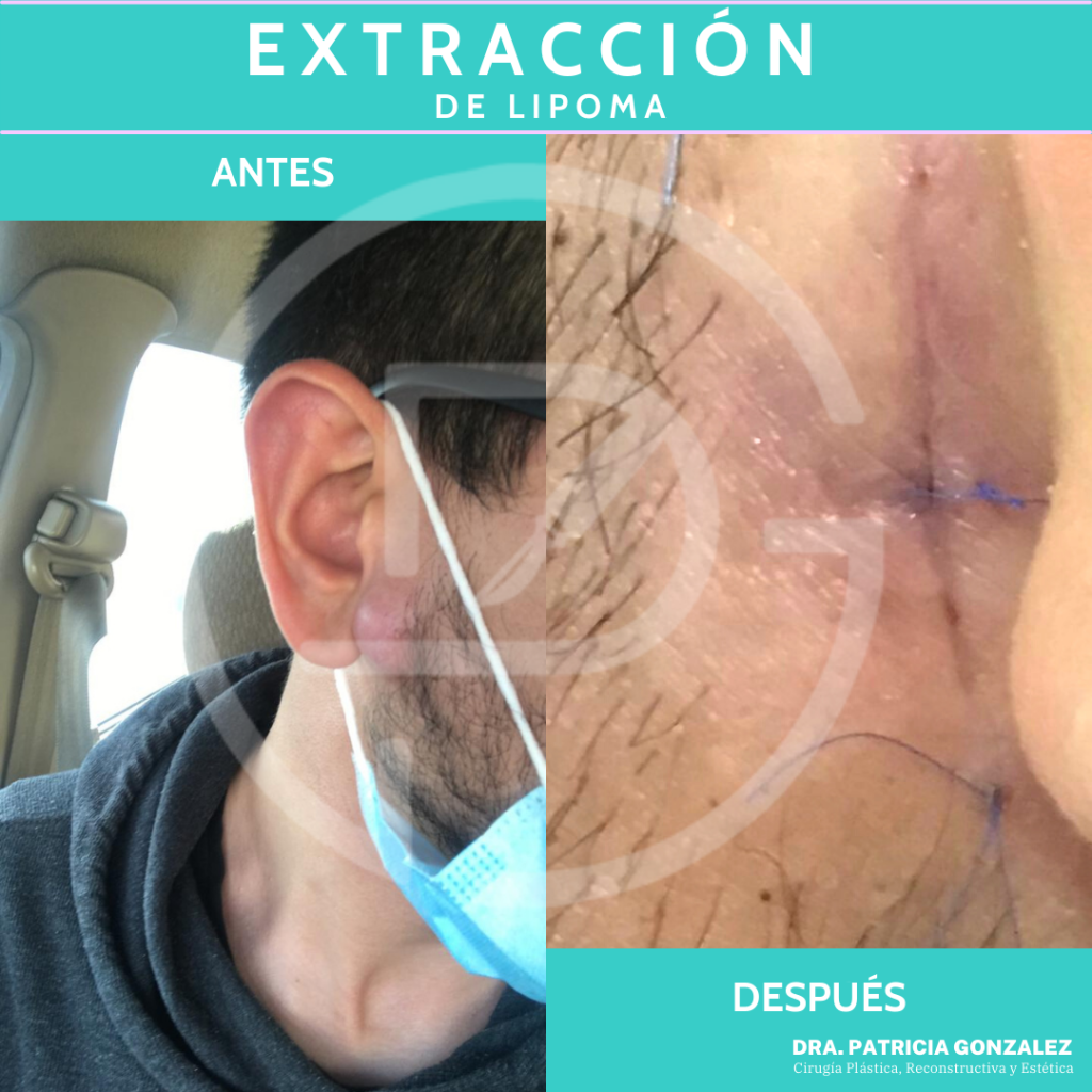 Lipoma