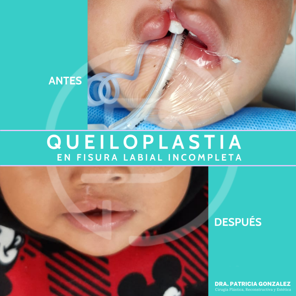 Queiloplastia