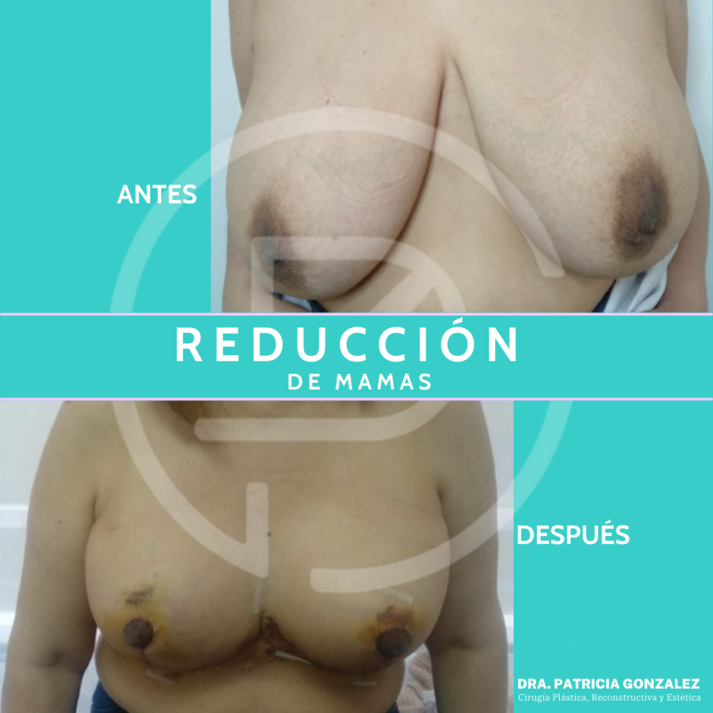 Reducción de mamas