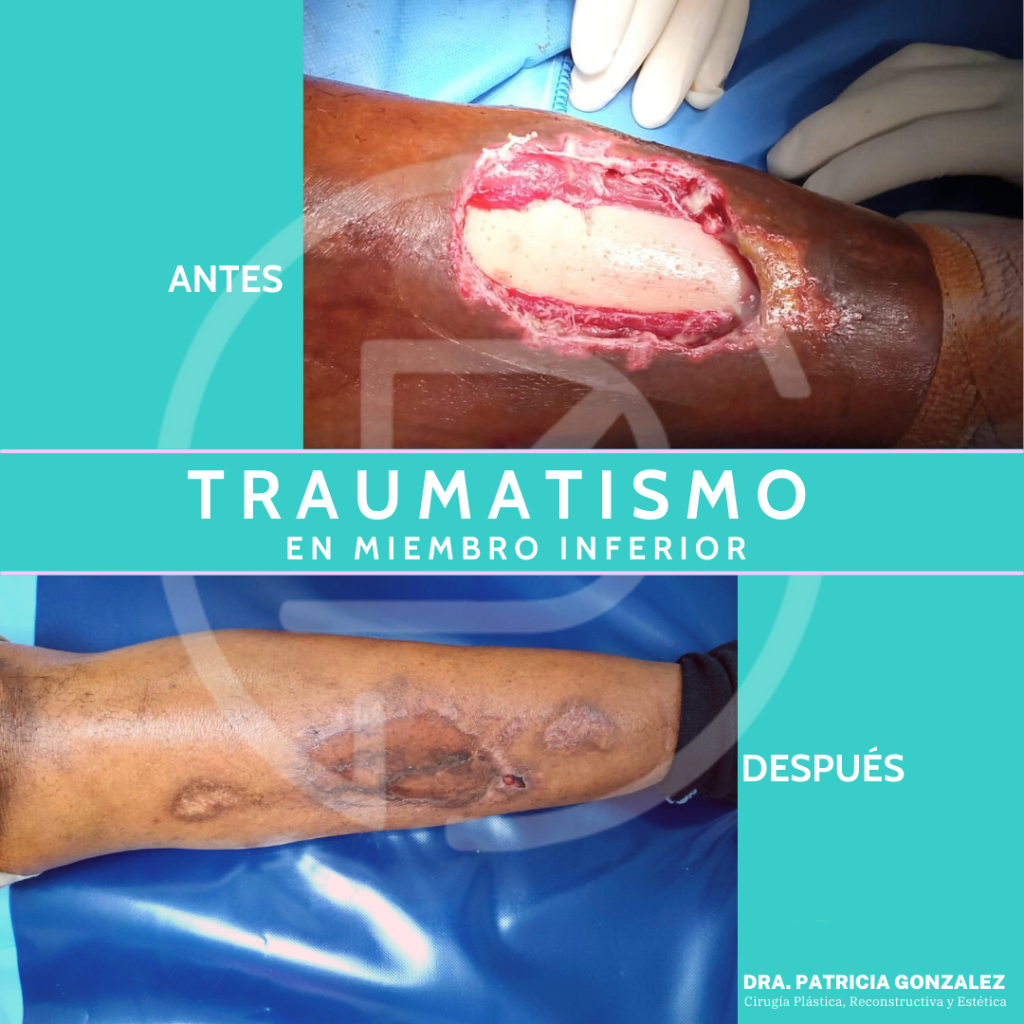 Traumatismo M. Inferior