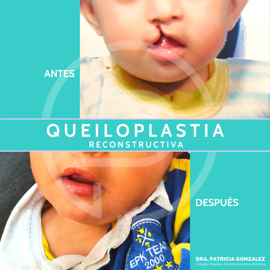 ueiloplastia 2